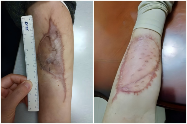 亿财配资 “双阶段真皮移植术”成功治愈复发性肉瘤，实现肿瘤根治与美学修复双突破